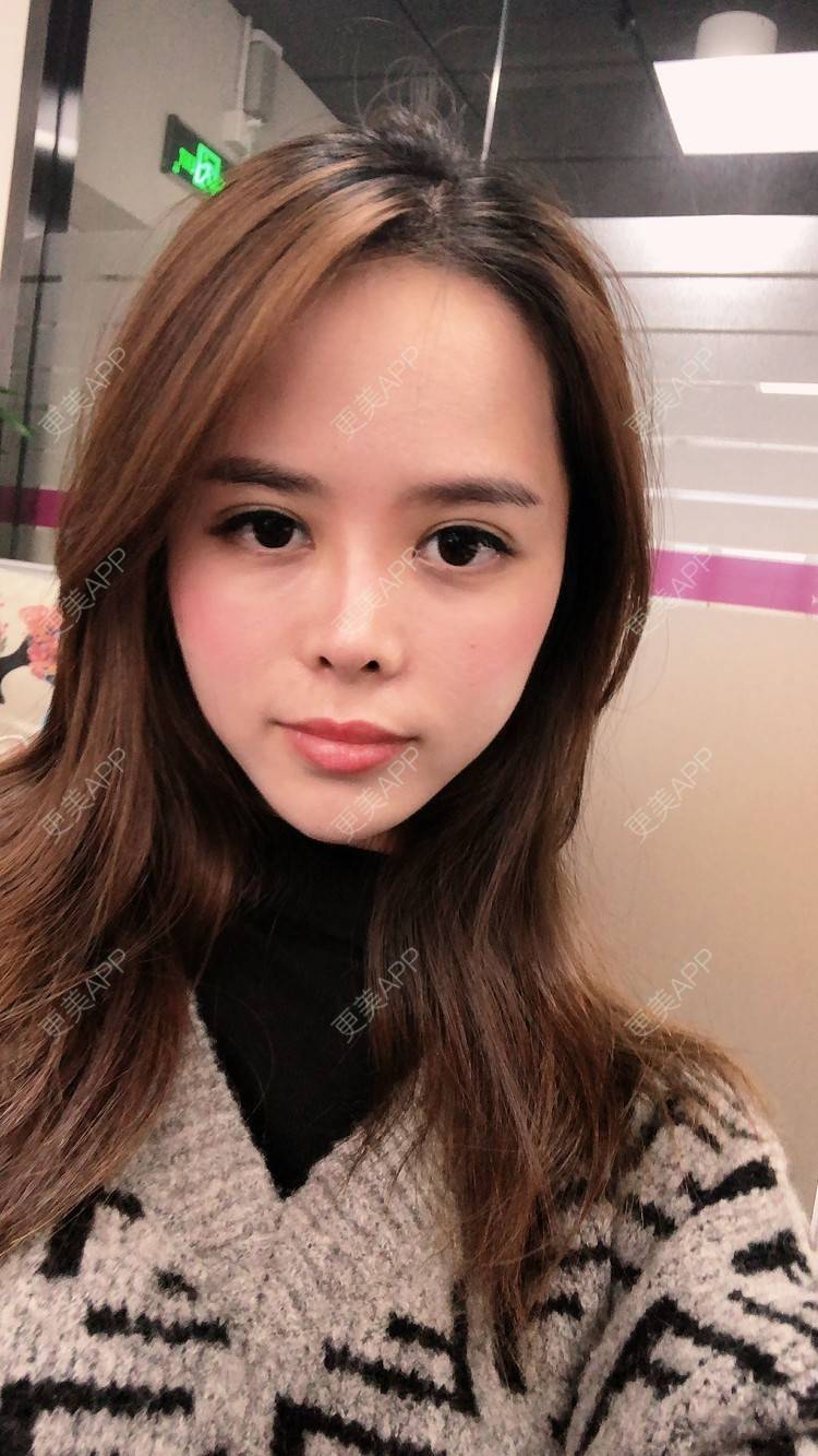 更美 - 更美用户M7EvKAD66P的玻尿酸经验 | 玻尿酸黑眼圈 | 玻尿酸面颊 | 玻尿酸 | 深圳