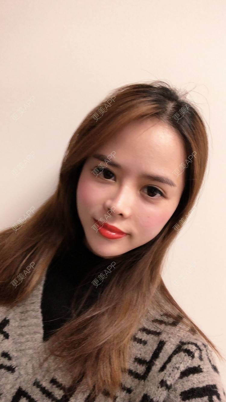 更美 - 更美用户M7EvKAD66P的玻尿酸经验 | 玻尿酸黑眼圈 | 玻尿酸面颊 | 玻尿酸 | 深圳