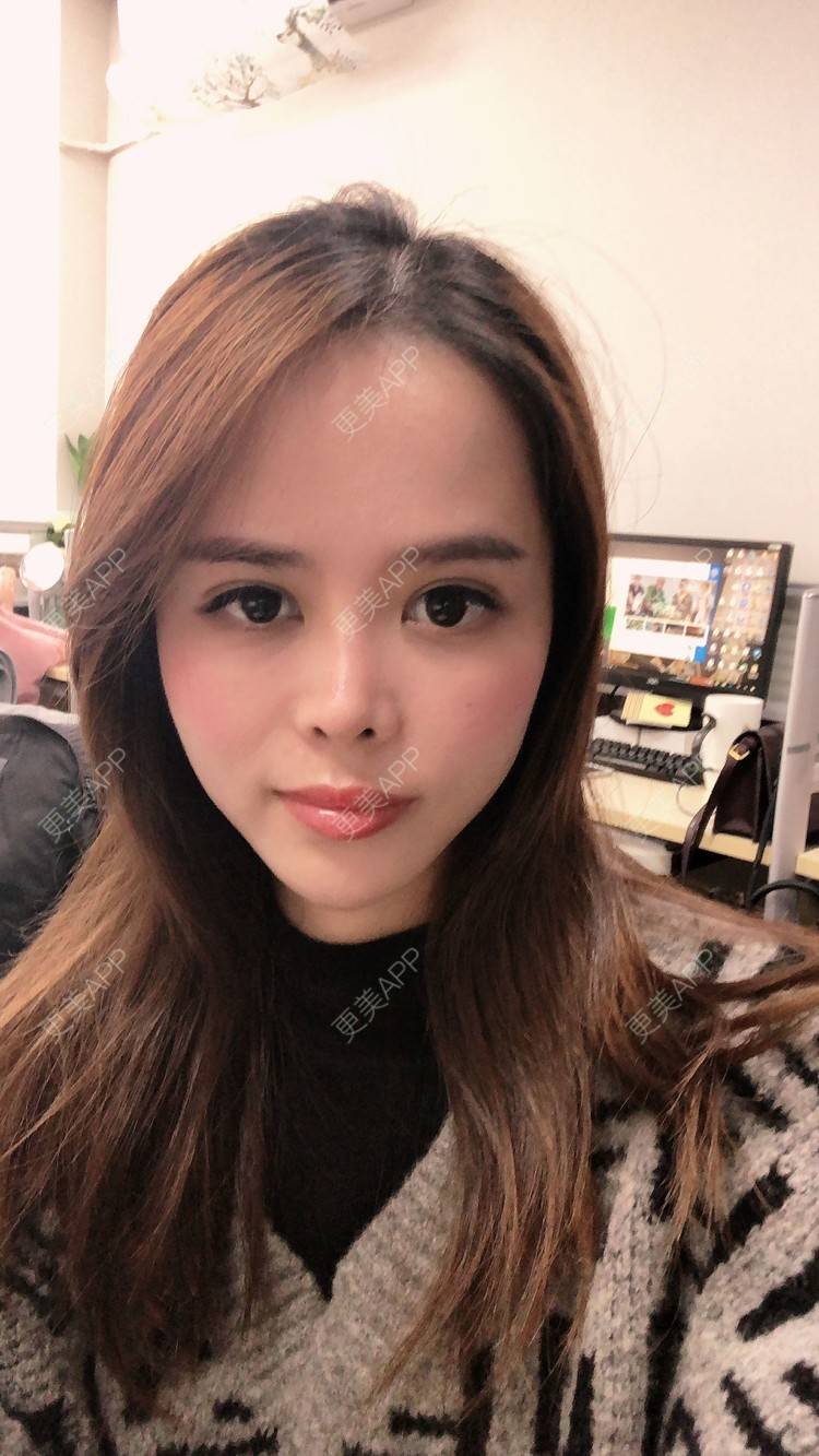 更美 - 更美用户M7EvKAD66P的玻尿酸经验 | 玻尿酸黑眼圈 | 玻尿酸面颊 | 玻尿酸 | 深圳