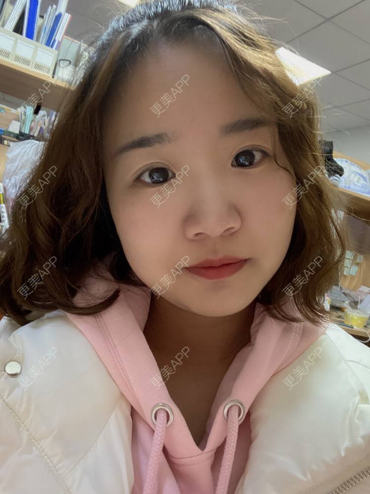 更美 - 更美用户8xg0IYZ1KR的定点双眼皮经验 | 定点双眼皮 | 长沙