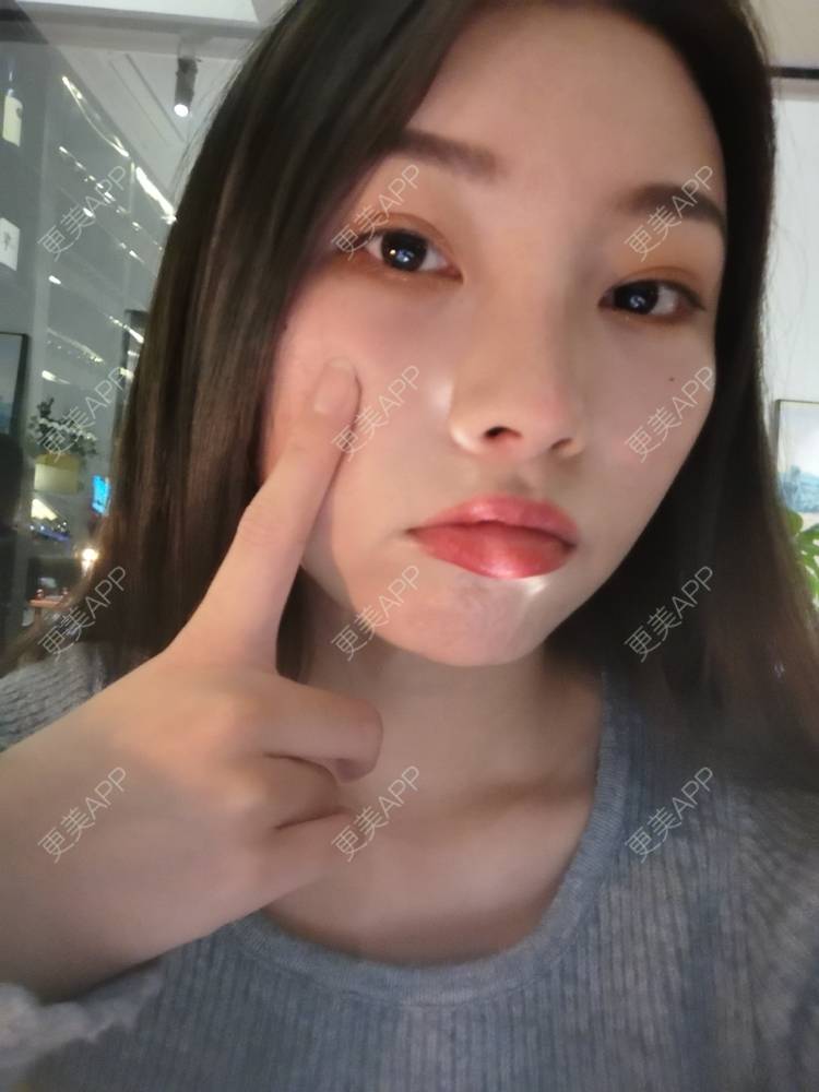 更美 - 更美用户82701801的隐形牙齿矫正经验 | 杭州