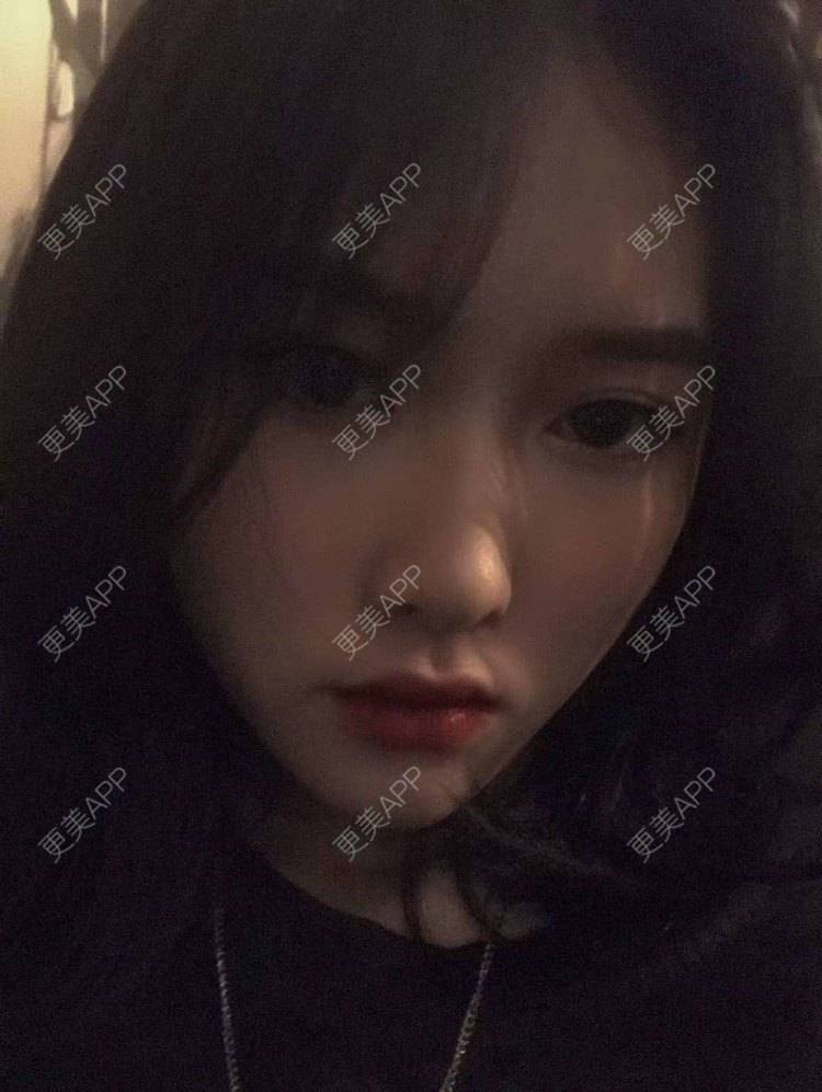 更美 - 心上人的身旁挤的经验 | 成都 | 激光淡疤 | 手术淡疤