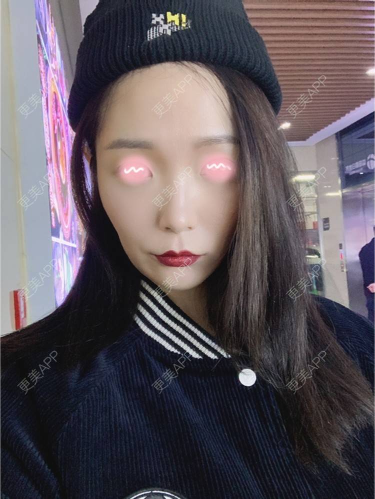 更美 - 橘子ʕ๑•ɷ•๑ʔ❀的玻尿酸鼻部经验 | 玻尿酸鼻部 | 西安 | 玻尿酸鼻基底