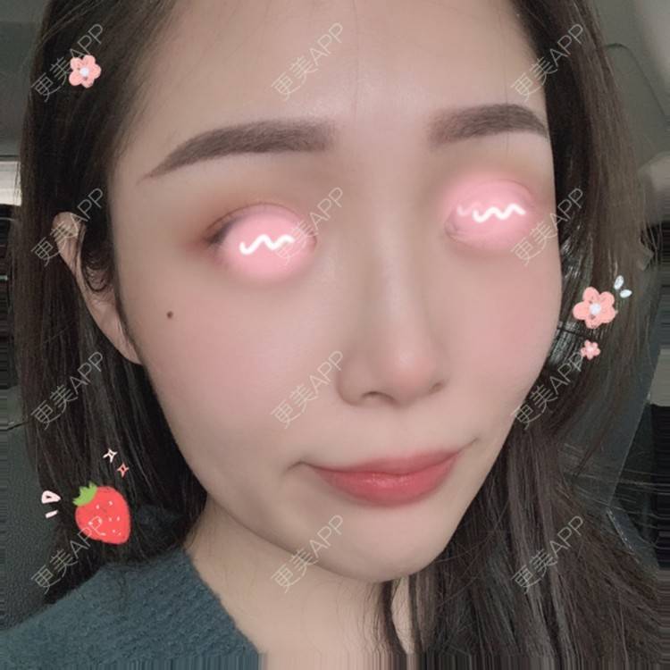 更美 - 橘子ʕ๑•ɷ•๑ʔ❀的玻尿酸鼻部经验 | 玻尿酸鼻部 | 西安 | 玻尿酸鼻基底