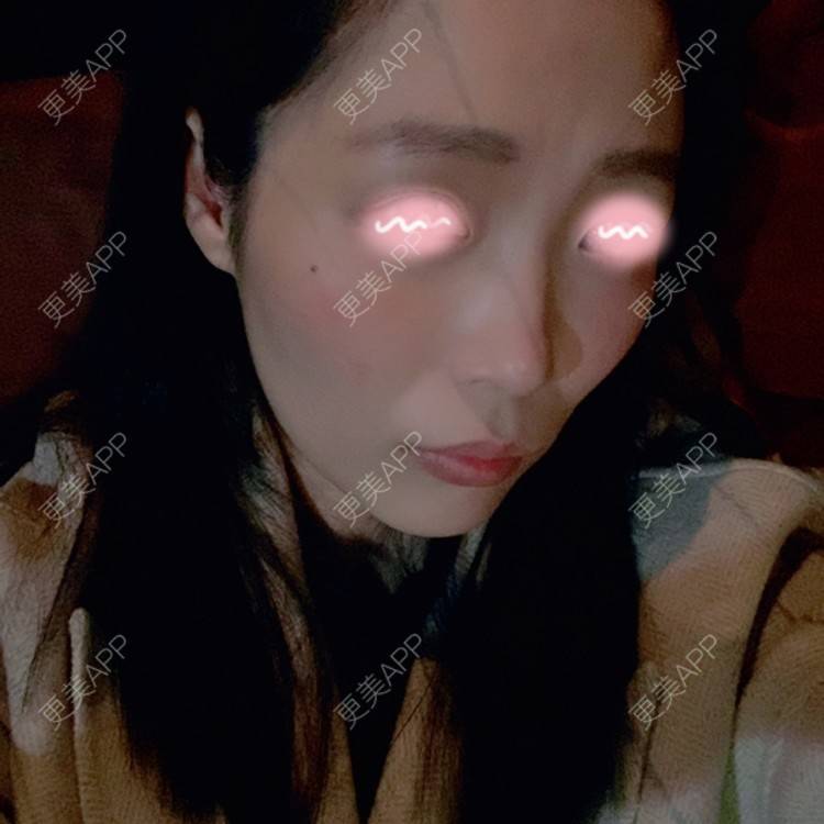 更美 - 橘子ʕ๑•ɷ•๑ʔ❀的玻尿酸鼻部经验 | 玻尿酸鼻部 | 西安 | 玻尿酸鼻基底