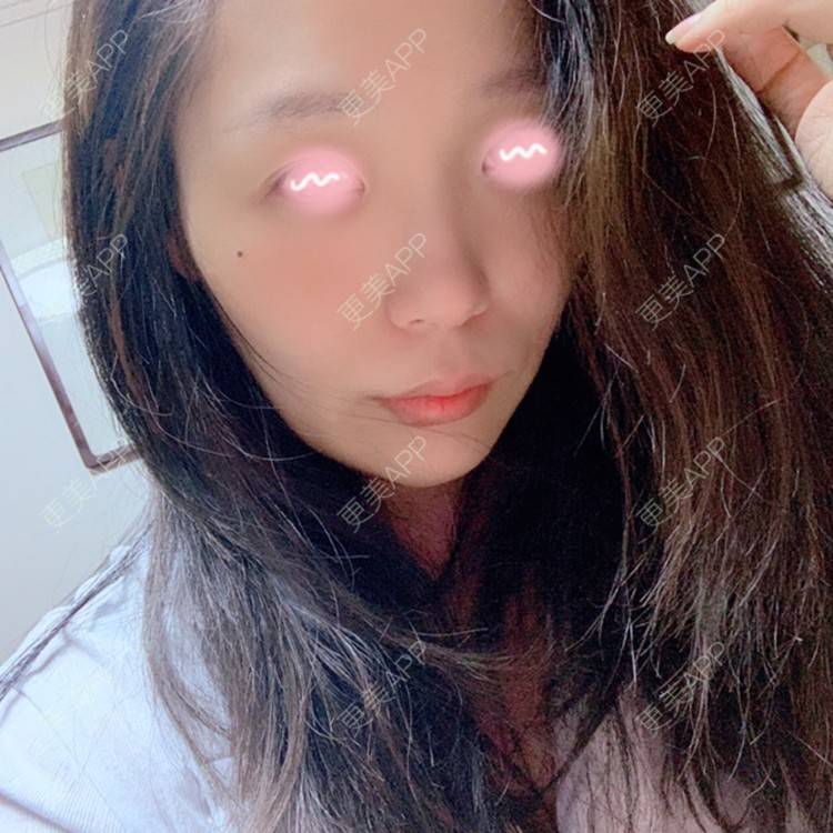 更美 - 橘子ʕ๑•ɷ•๑ʔ❀的玻尿酸鼻部经验 | 玻尿酸鼻部 | 西安 | 玻尿酸鼻基底