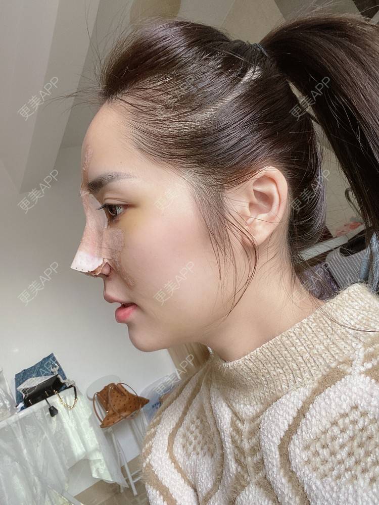 更美 - 小南湘湘的肋软骨隆鼻经验 | 肋软骨隆鼻 | 隆鼻 | 视频日记 | 南宁