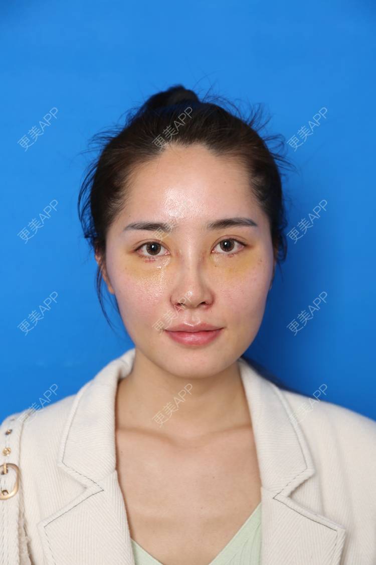 更美 - 小南湘湘的肋软骨隆鼻经验 | 肋软骨隆鼻 | 视频日记 | 南宁