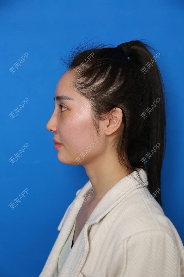 更美 - 小南湘湘的肋软骨隆鼻经验 | 肋软骨隆鼻 | 视频日记 | 南宁