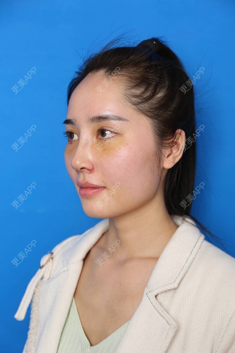 更美 - 小南湘湘的肋软骨隆鼻经验 | 肋软骨隆鼻 | 视频日记 | 南宁