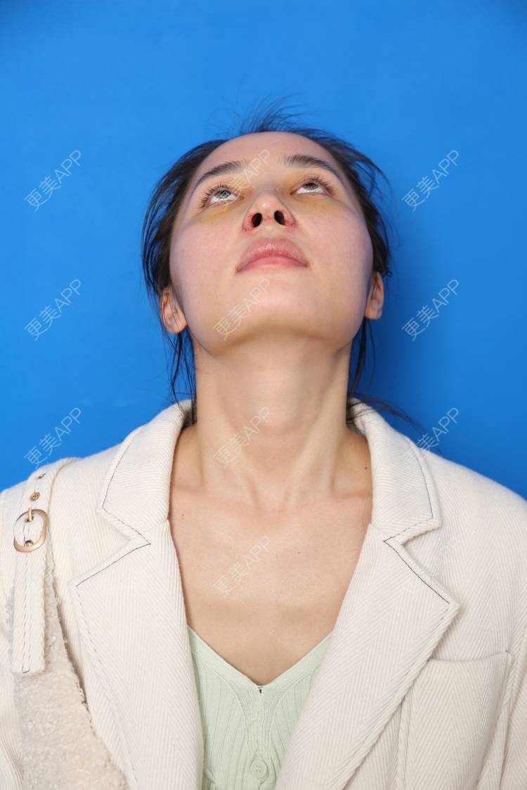 更美 - 小南湘湘的肋软骨隆鼻经验 | 肋软骨隆鼻 | 视频日记 | 南宁