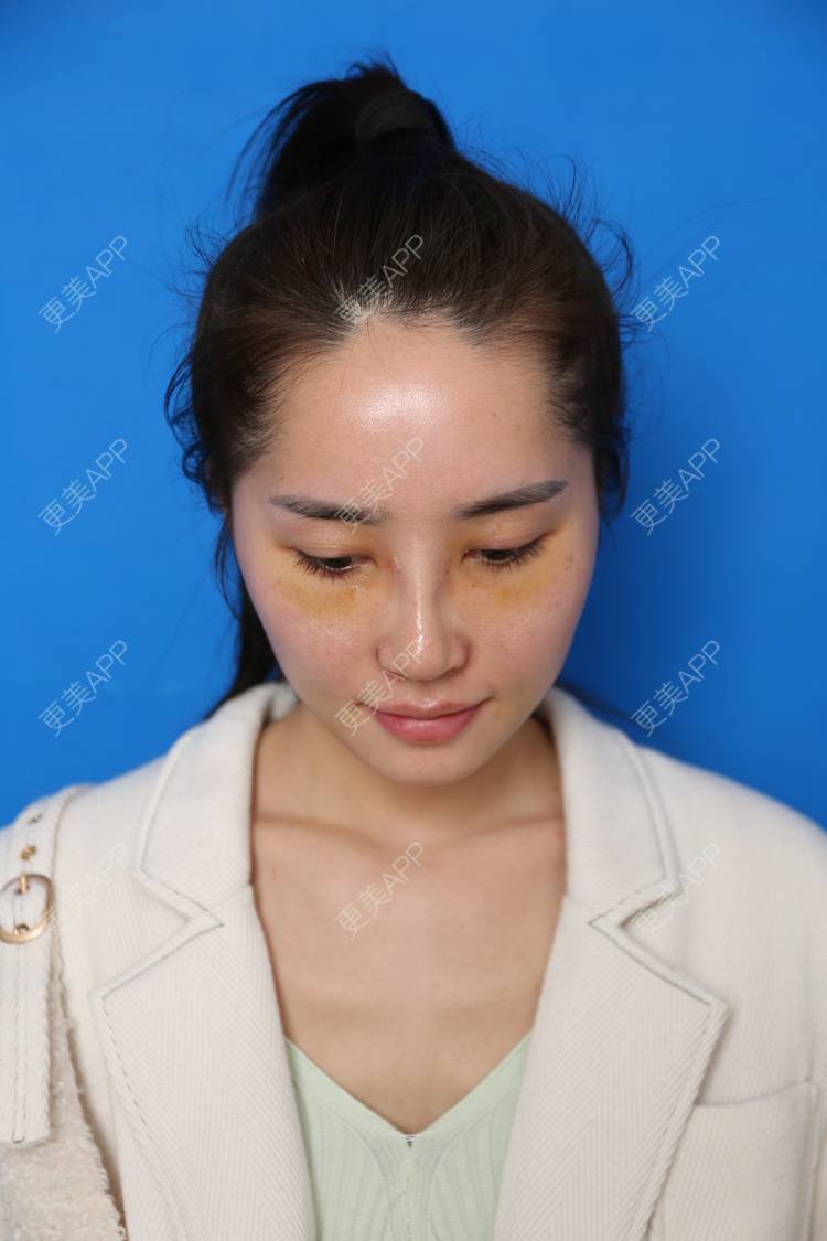 更美 - 小南湘湘的肋软骨隆鼻经验 | 肋软骨隆鼻 | 视频日记 | 南宁