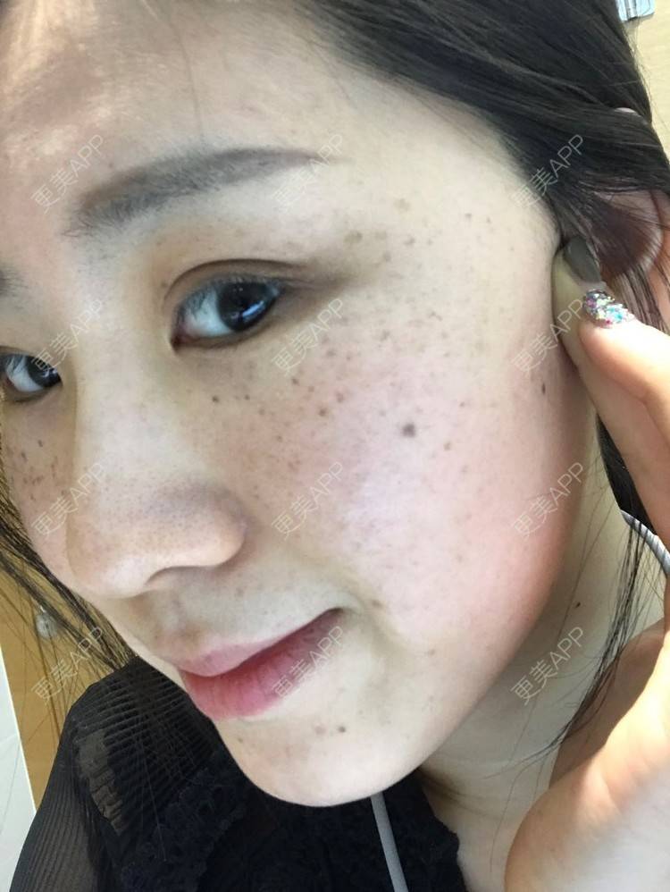 更美 - 戏子的眼泪的淡斑套餐经验 | 淡斑套餐 | 南昌