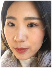 更美 - 戏子的眼泪的淡斑套餐经验 | 淡斑套餐 | 南昌