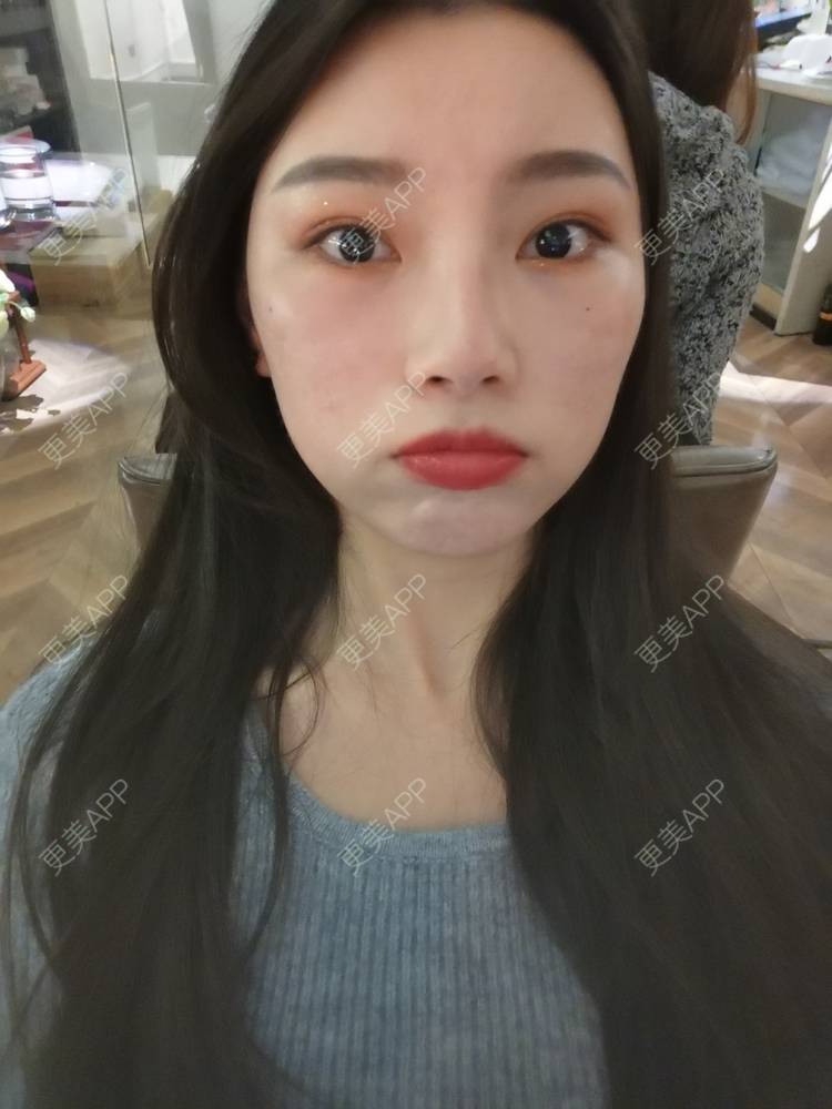 更美 - 更美用户82701801的隐形牙齿矫正经验 | 杭州