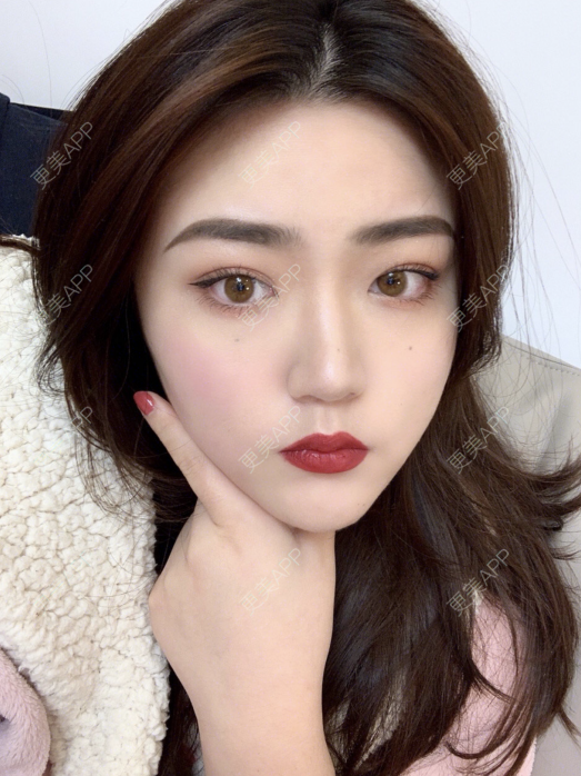 更美用户3rqx9eoots的埋线双眼皮日记