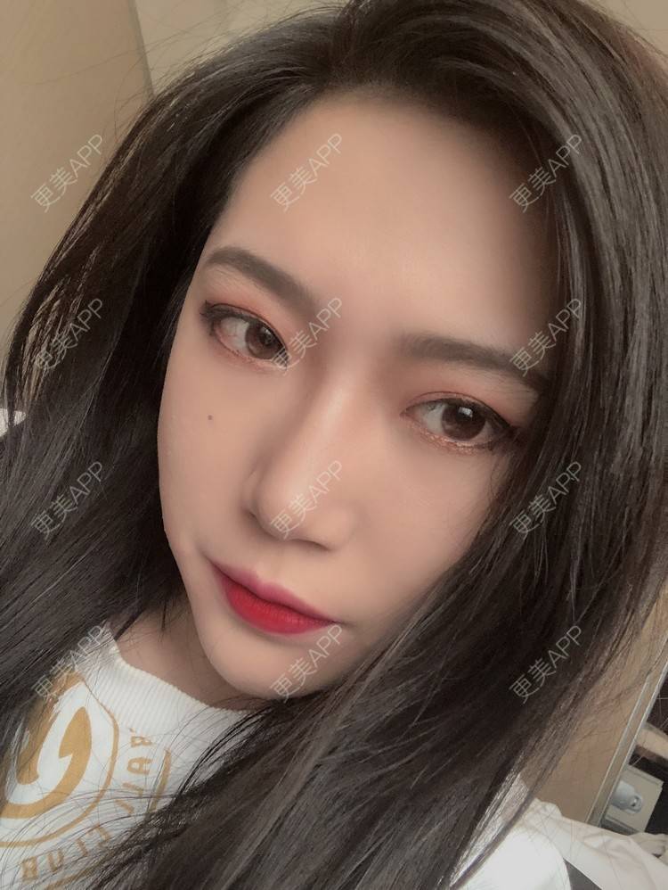 更美 - L李小豆儿的鼻部多项经验 | 杭州 | 视频日记 | 鼻部多项