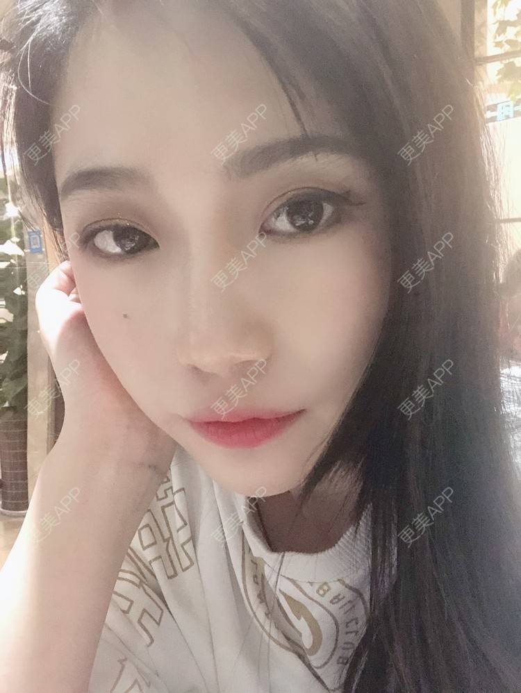 更美 - L李小豆儿的鼻部多项经验 | 杭州 | 视频日记 | 鼻部多项