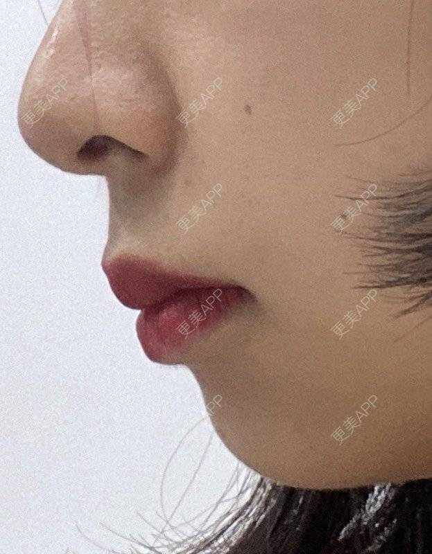 更美 - 更美用户8l1O3VgTkN的玻尿酸下巴经验 | 武汉 | 玻尿酸下巴