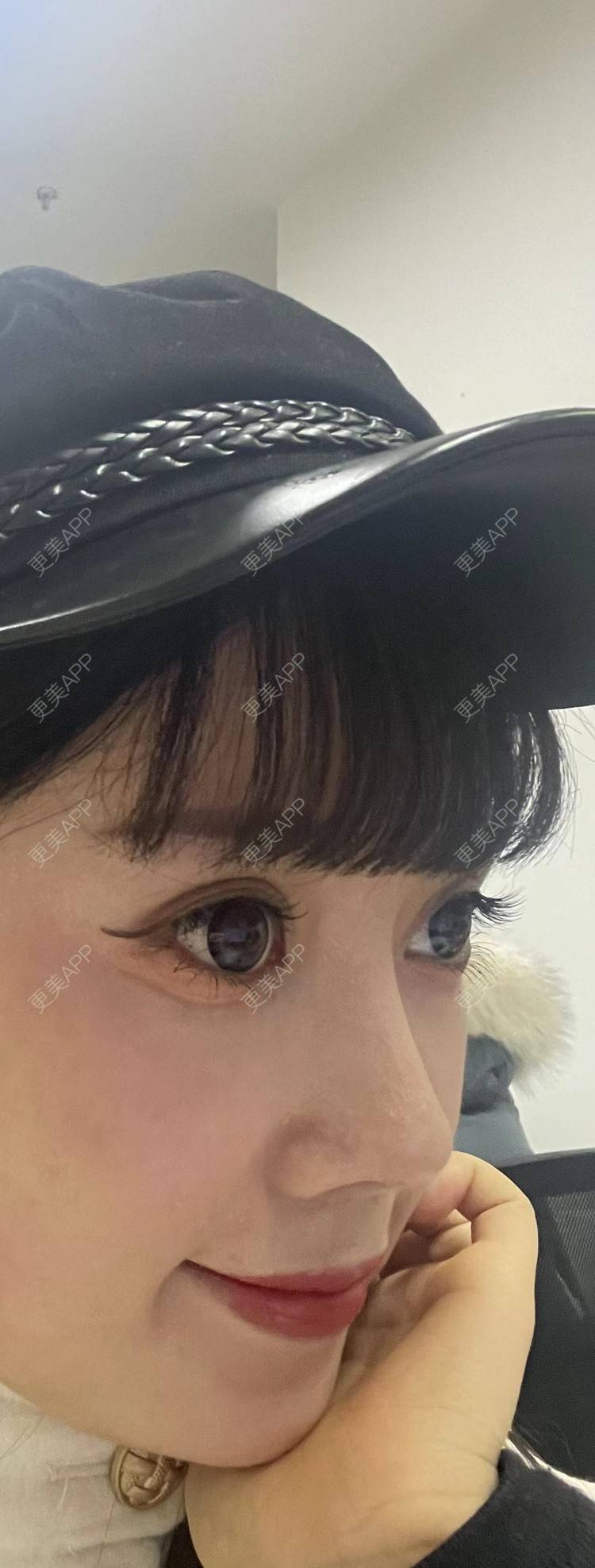 更美 - 彩泥宝贝的鼻部多项经验 | 肋软骨隆鼻 | 鼻部膨体假体取出 | 鼻形态修复 | 鼻部硅胶假体取出 | 鼻部多项 | 鼻部修复 | 鼻翼缩小 | 耳软骨隆鼻
