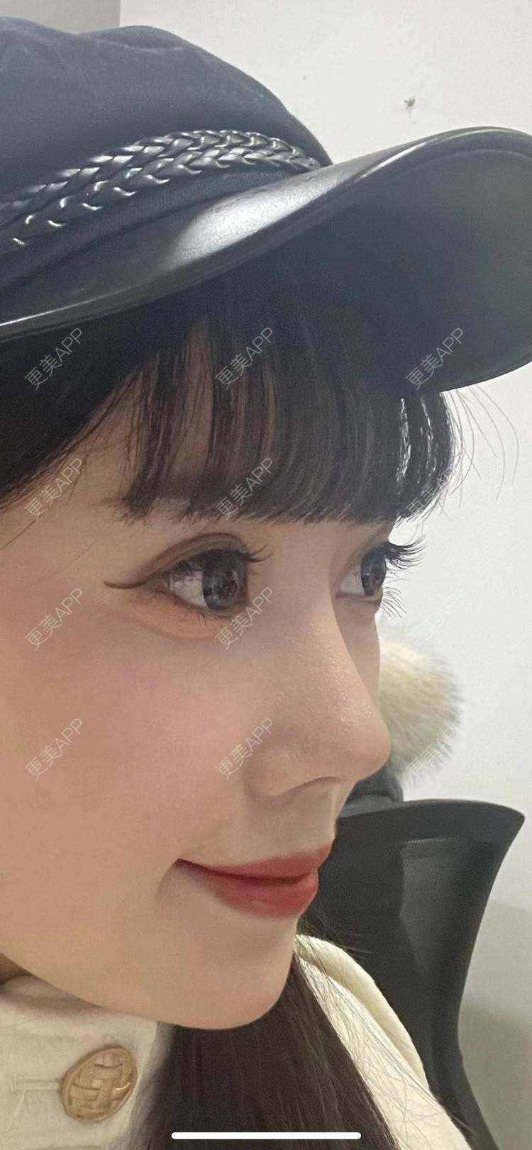 更美 - 彩泥宝贝的鼻部多项经验 | 肋软骨隆鼻 | 鼻部膨体假体取出 | 鼻形态修复 | 鼻部硅胶假体取出 | 鼻部多项 | 鼻部修复 | 鼻翼缩小 | 耳软骨隆鼻