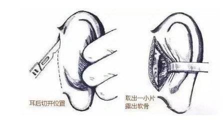 更美 - 吴松 医生的耳软骨隆鼻经验 | 耳软骨隆鼻 | 重庆
