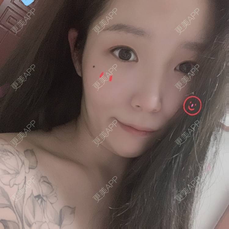 更美 - 橘子ʕ๑•ɷ•๑ʔ❀的玻尿酸法令纹经验 | 西安 | 玻尿酸法令纹