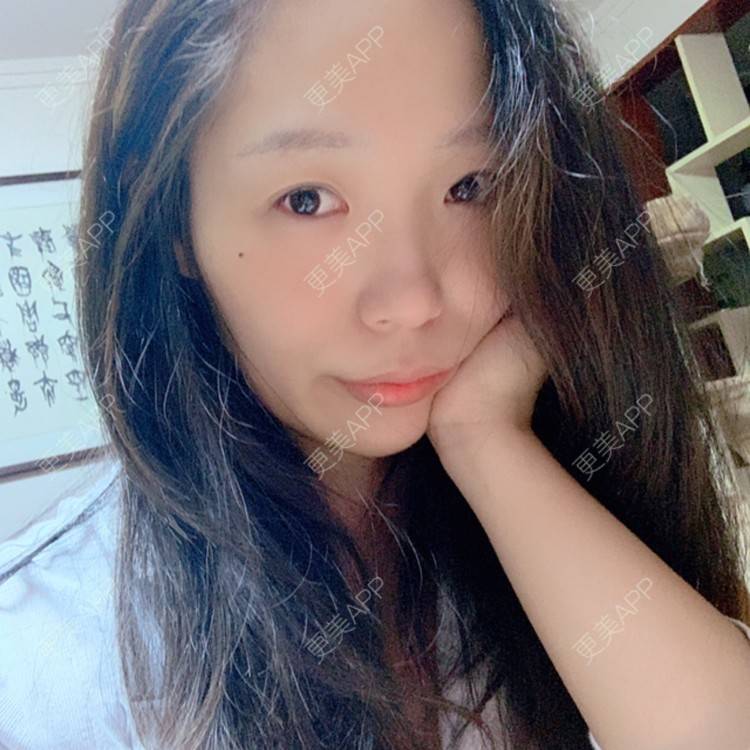 更美 - 橘子ʕ๑•ɷ•๑ʔ❀的玻尿酸法令纹经验 | 西安 | 玻尿酸法令纹