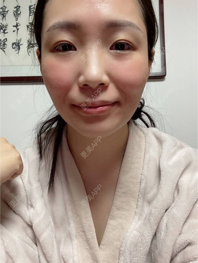 更美 - 橘子ʕ๑•ɷ•๑ʔ❀的玻尿酸法令纹经验 | 西安 | 玻尿酸法令纹