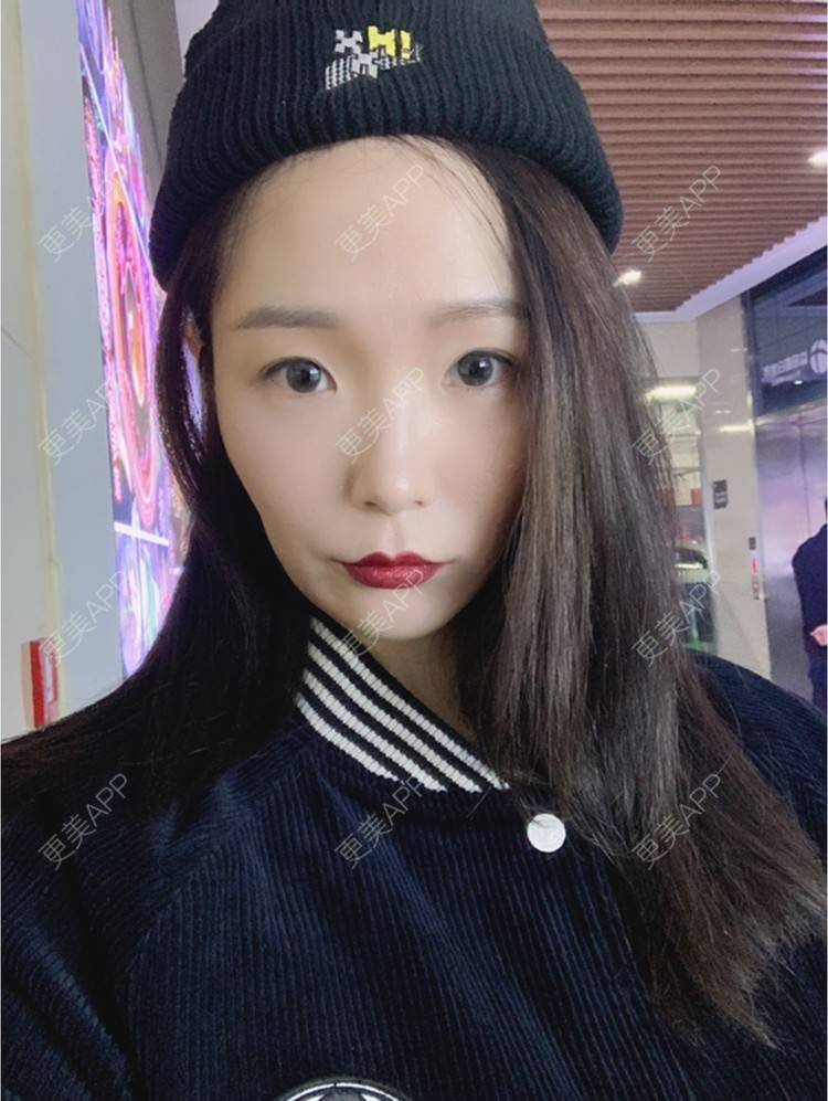 更美 - 橘子ʕ๑•ɷ•๑ʔ❀的玻尿酸鼻部经验 | 玻尿酸鼻部 | 西安 | 玻尿酸鼻基底