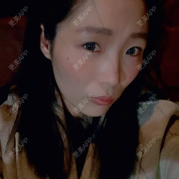 更美 - 橘子ʕ๑•ɷ•๑ʔ❀的玻尿酸鼻部经验 | 玻尿酸鼻部 | 西安 | 玻尿酸鼻基底