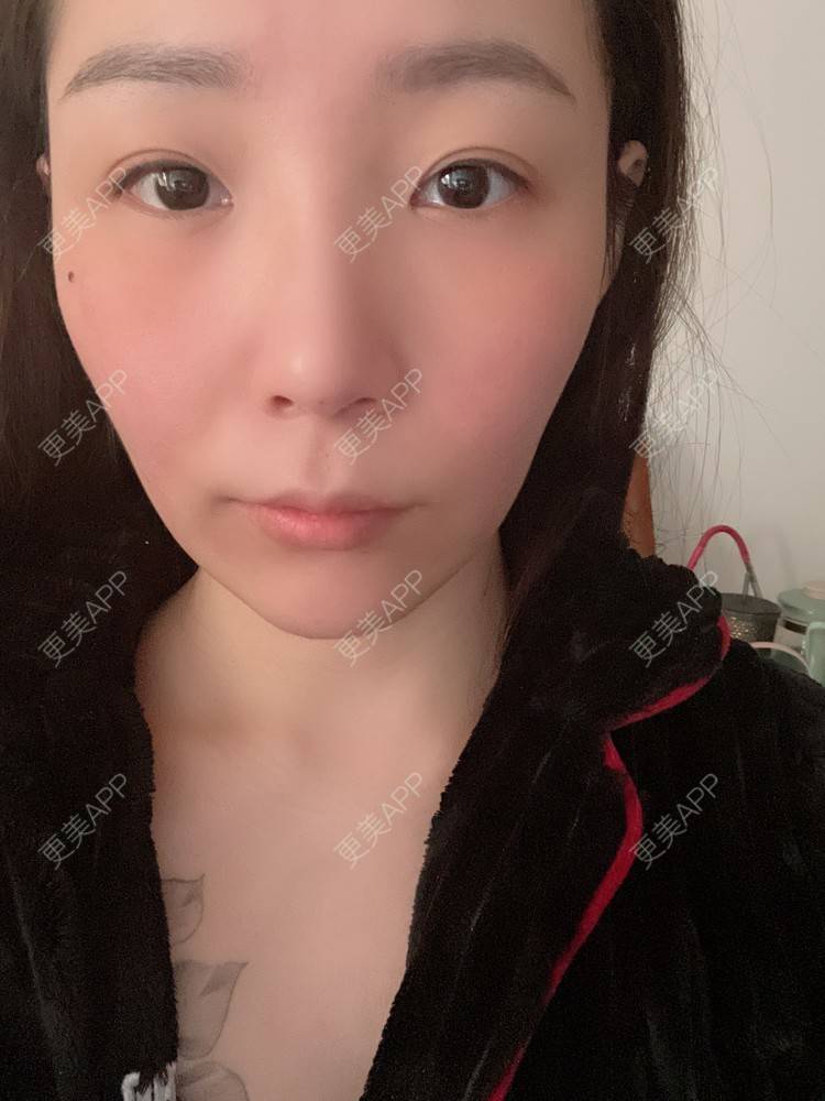 更美 - 橘子ʕ๑•ɷ•๑ʔ❀的玻尿酸鼻部经验 | 玻尿酸鼻部 | 西安 | 玻尿酸鼻基底