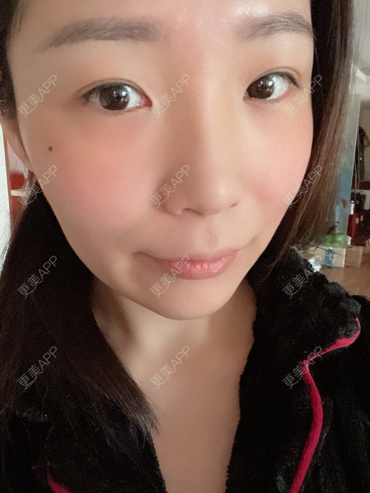 更美 - 橘子ʕ๑•ɷ•๑ʔ❀的玻尿酸鼻部经验 | 玻尿酸鼻部 | 西安 | 玻尿酸鼻基底