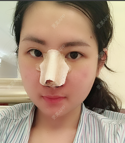 更美 - 薇薇卡安的肋软骨隆鼻经验 | 膨体隆鼻 | 肋软骨隆鼻 | 隆鼻 | 南宁