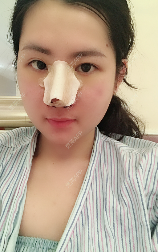 更美 - 薇薇卡安的肋软骨隆鼻经验 | 膨体隆鼻 | 肋软骨隆鼻 | 隆鼻 | 南宁