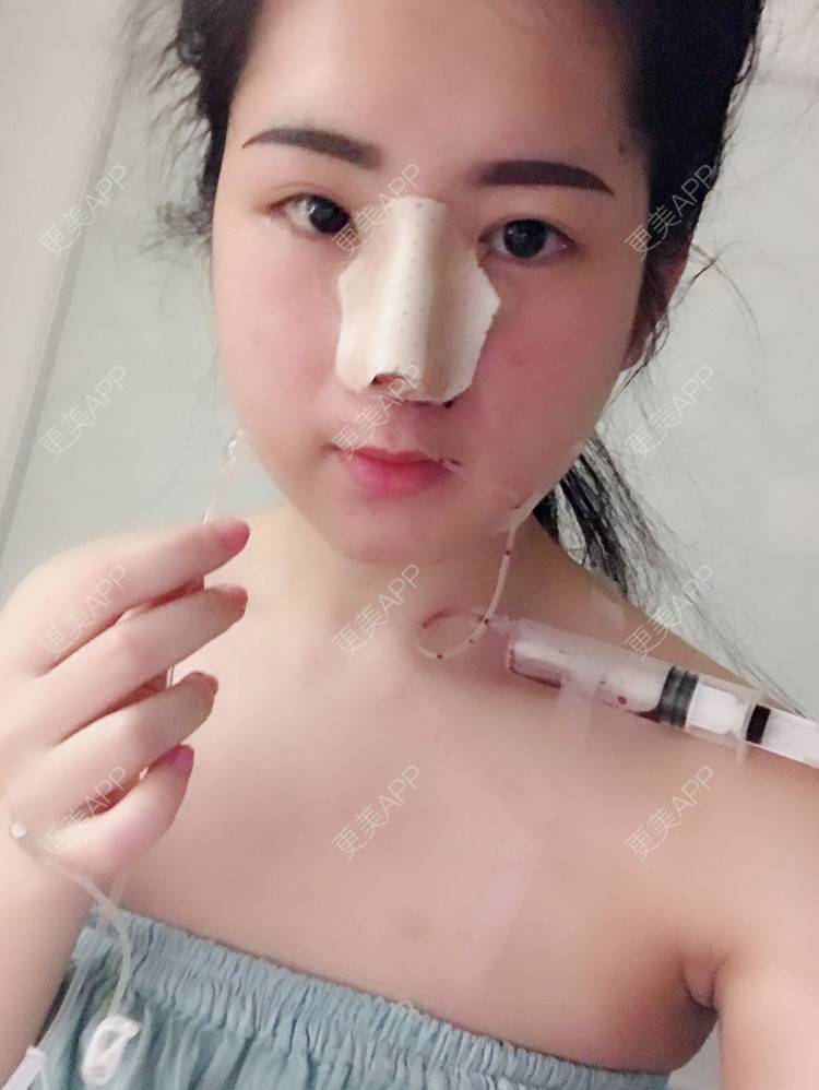 更美 - 薇薇卡安的肋软骨隆鼻经验 | 膨体隆鼻 | 肋软骨隆鼻 | 隆鼻 | 南宁