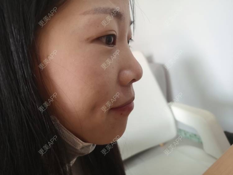 更美 - 更美用户gNaMcwYz59的酒窝成形经验 | 酒窝成形 | 深圳