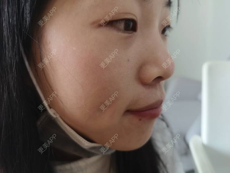 更美 - 更美用户gNaMcwYz59的酒窝成形经验 | 酒窝成形 | 深圳