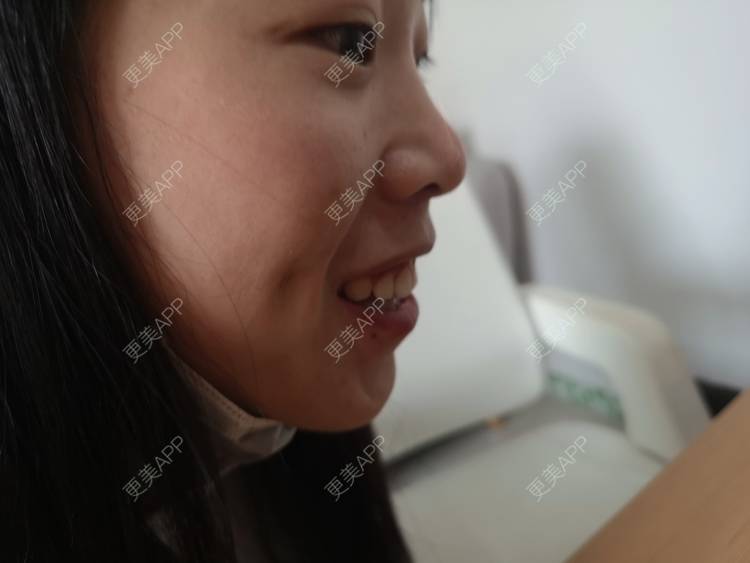 更美 - 更美用户gNaMcwYz59的酒窝成形经验 | 酒窝成形 | 深圳