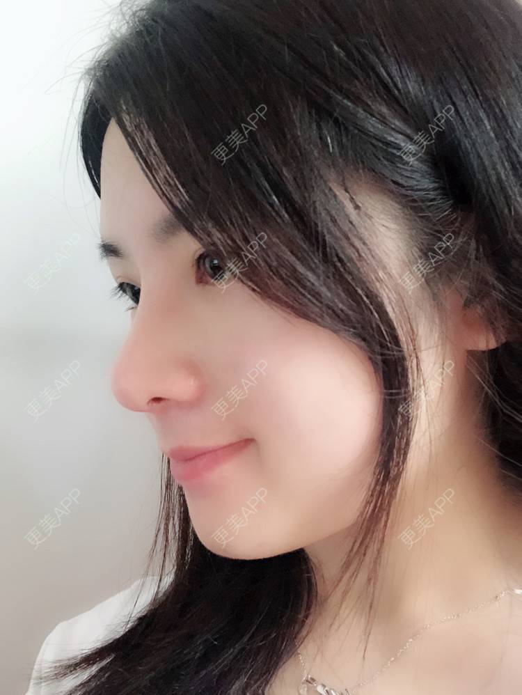 更美 - 薇薇卡安的肋软骨隆鼻经验 | 硅胶隆鼻 | 肋软骨隆鼻 | 隆鼻 | 南宁