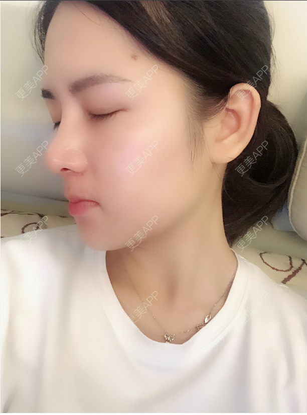 更美 - 薇薇卡安的肋软骨隆鼻经验 | 硅胶隆鼻 | 肋软骨隆鼻 | 隆鼻 | 南宁