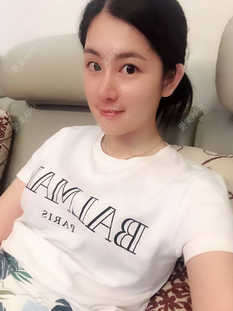 更美 - 薇薇卡安的肋软骨隆鼻经验 | 硅胶隆鼻 | 肋软骨隆鼻 | 隆鼻 | 南宁