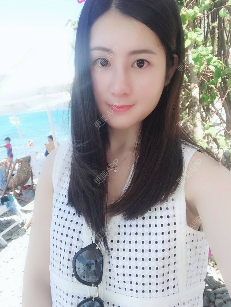 更美 - 薇薇卡安的肋软骨隆鼻经验 | 肋软骨隆鼻 | 南宁