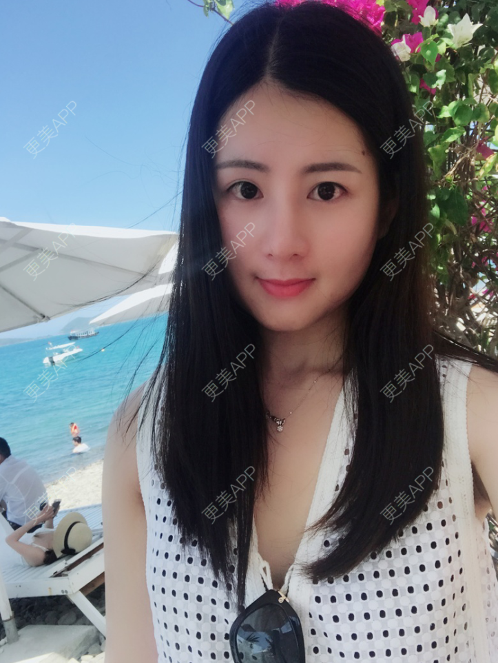 更美 - 薇薇卡安的肋软骨隆鼻经验 | 肋软骨隆鼻 | 南宁