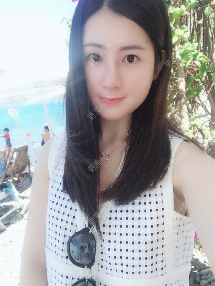 更美 - 薇薇卡安的肋软骨隆鼻经验 | 肋软骨隆鼻 | 南宁