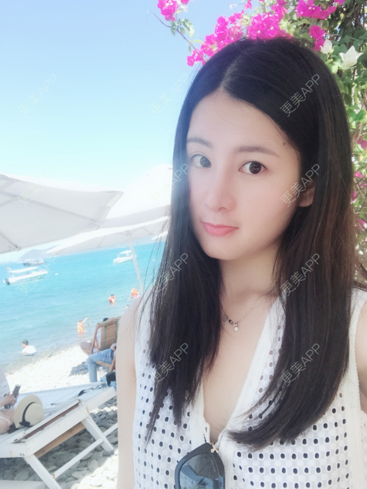 更美 - 薇薇卡安的肋软骨隆鼻经验 | 肋软骨隆鼻 | 南宁