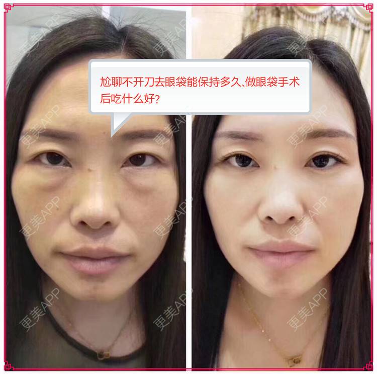 更美 - 情言泼的内切去眼袋经验 | 北京 | 内切去眼袋