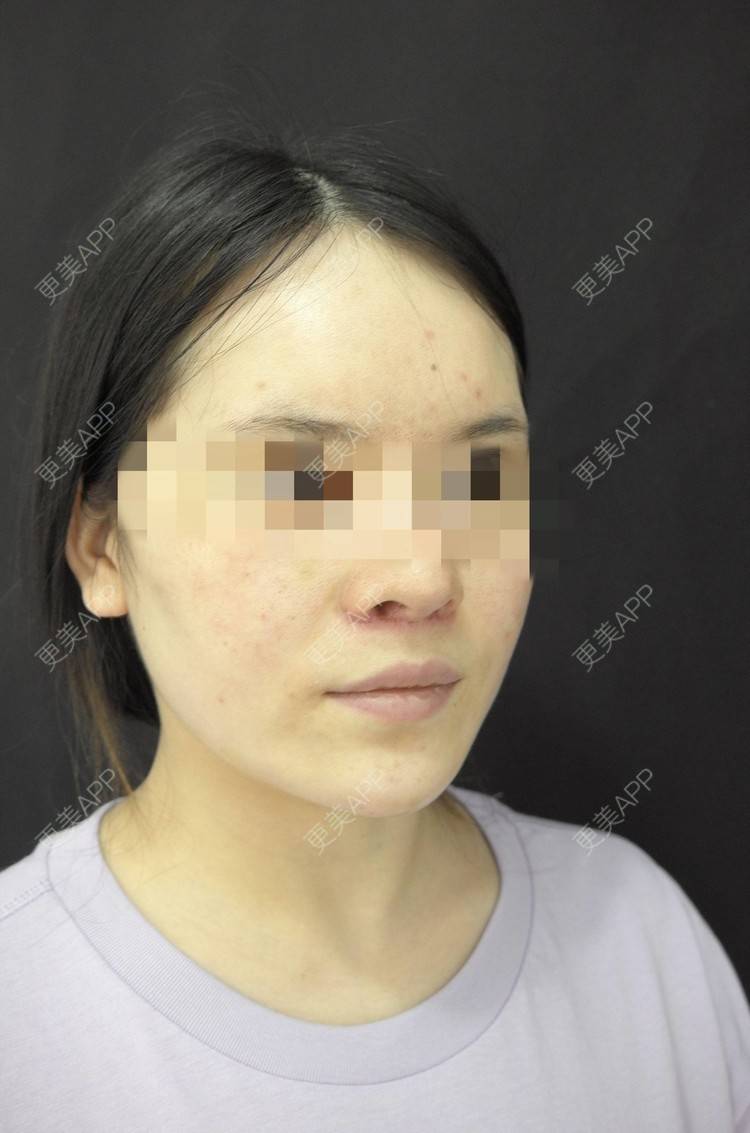 更美 - 小小板板凳凳儿的人中缩短经验 | 人中缩短