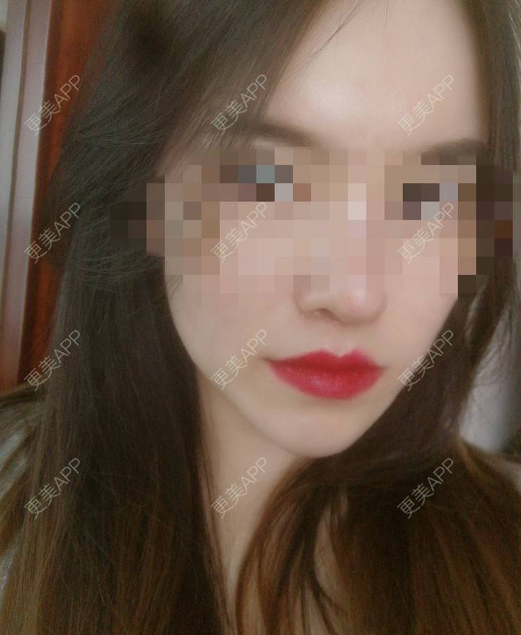 更美 - 小小板板凳凳儿的人中缩短经验 | 人中缩短