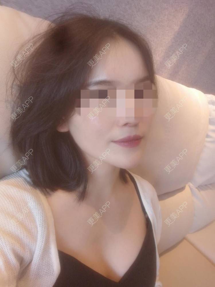 更美 - 小小板板凳凳儿的人中缩短经验 | 人中缩短
